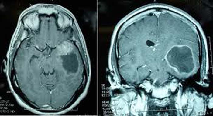 Глиальная опухоль головного. Опухоль мозга глиобластома. Опухоль головного мозга глиобластома 4. Онкология глиобластома. Неоперабельная глиома головного мозга.