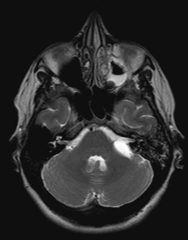 MRI: Axial T2w image